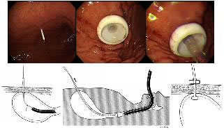내시경적 경피루 위루술