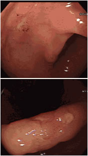 위십이지장 궤양