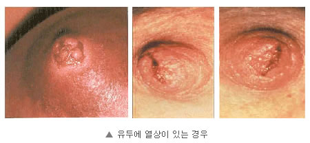 유두에 열상이 있는 경우