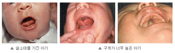 아기가 유방에 올바르게 접촉하지 못할 때