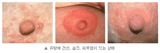 유두에 모유수포(milk blister)가 생겼을 경우