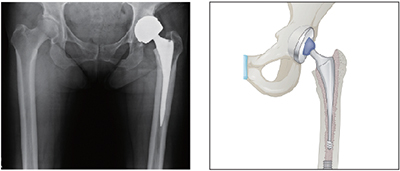 고관절인공관절치환술