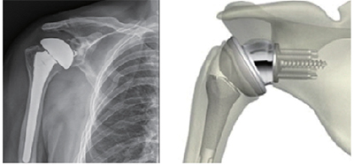어깨관절인공관절치환술