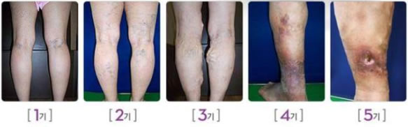 하지정맥류의 병기